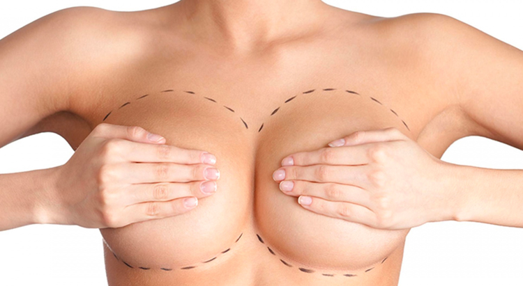 Что важно знать о коррекции груди?