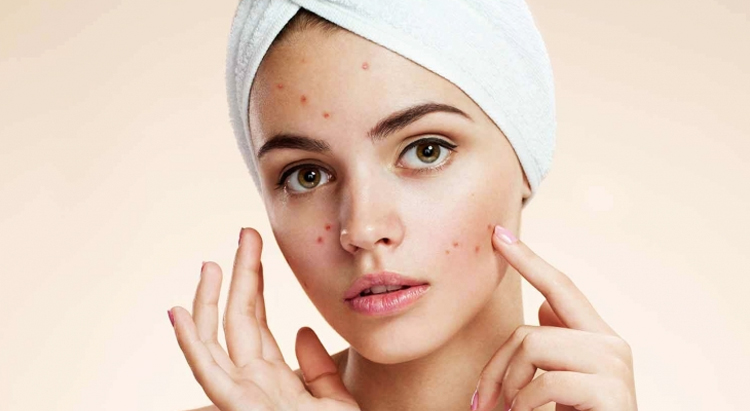 Акне (acne vulgaris)