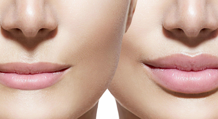 Зачем женщины увеличивают губы и чего ожидают после процедуры?